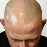 What To Expect After Your Scalp Tattoo Treatment
