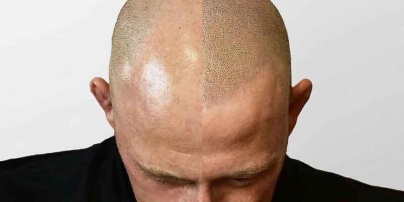 What To Expect After Your Scalp Tattoo Treatment