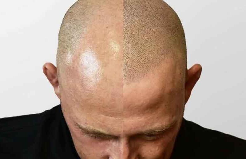 What To Expect After Your Scalp Tattoo Treatment